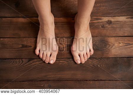 Hllux Valgus On Female Legs Close Up On Wooden Background. Foot Joint Deformity. Health Care And Med