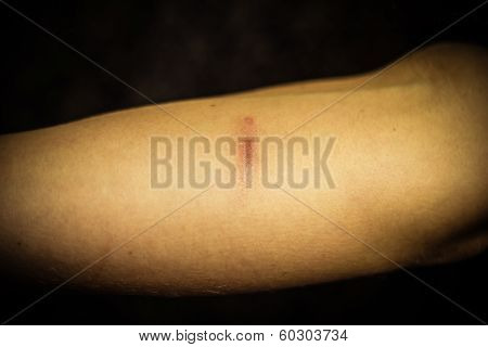 Woman's Forearm With Scar From Self Harm