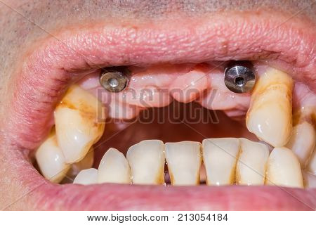 Two canine dental implants in the mouth of a patient with advanced periodontitis