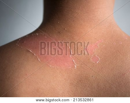 peeling skin at back and shoulder from sunburn effect on body of young man from sunbath at summer. dangerous sunburn concept
