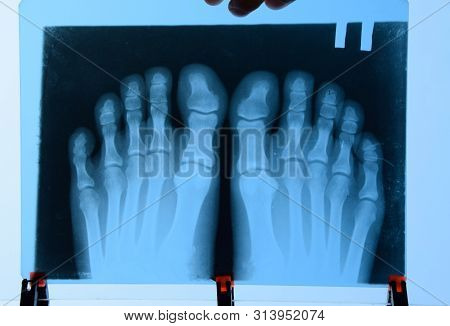 X-ray Of Toes. Foot On X-ray. Bone Research