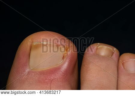 Close-up Photo Of A Toenail Infection In Human