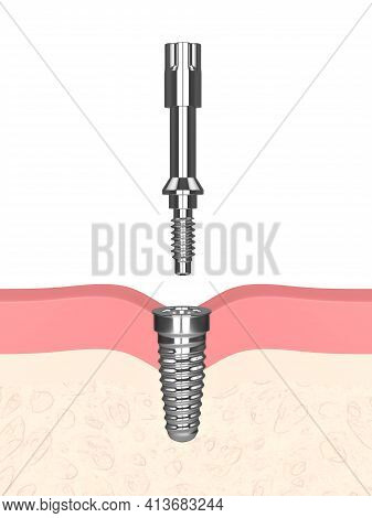 3d Render Of Dental Implant With Multipeg To Check Implant Stability