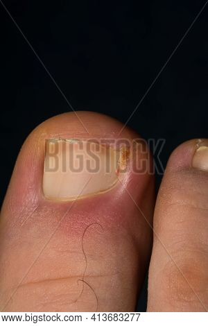 Close-up Photo Of A Toenail Infection In Human