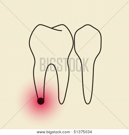 Toothache - Pulpitis