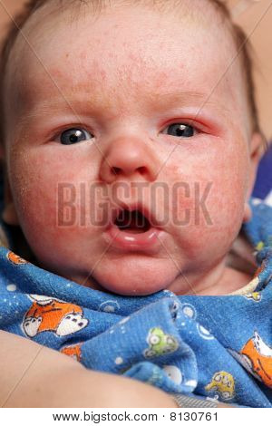 Criança com diátese alérgica