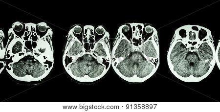 Ct Scan Of Brain And Base Of Skull