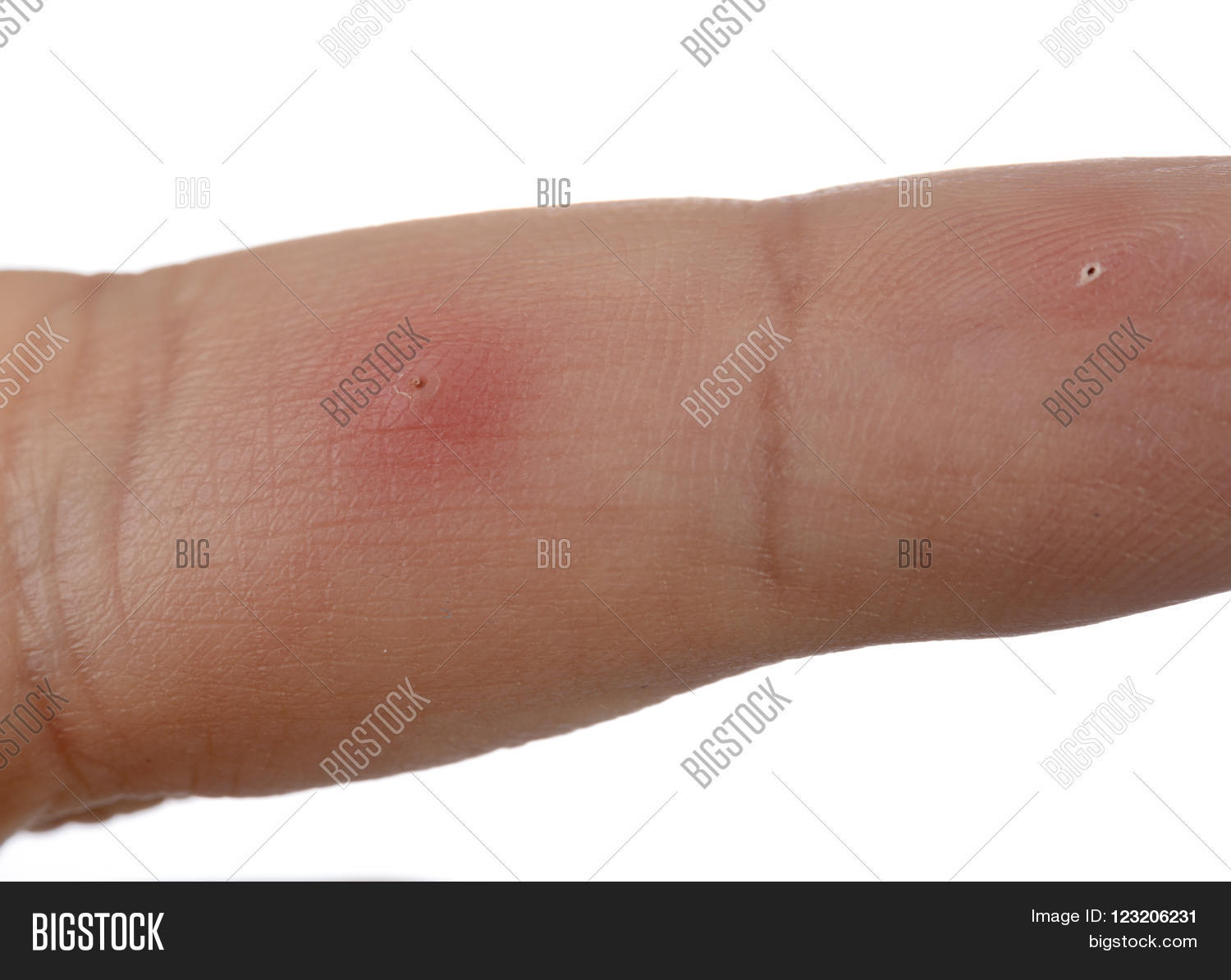 Splinter Finger Close Image & Photo (Free Trial) Bigstock