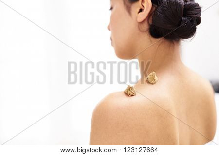 Moxibustion acupuncture needles heat on woman shoulder