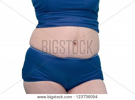 Woman in swim suit showing her stretch mark