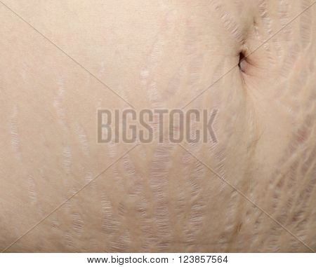 Closeup stretch marks at asian woman belly