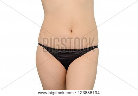 Asian woman showing  stretch marks at her belly