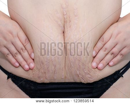 Closeup stretch marks at asian woman belly