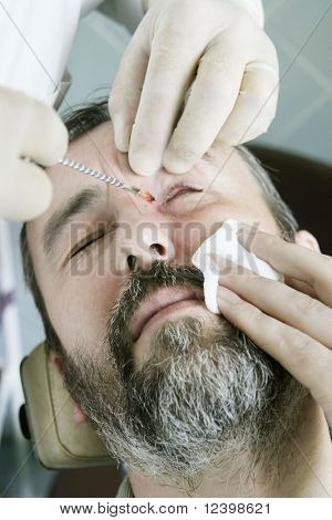 Microcirugía