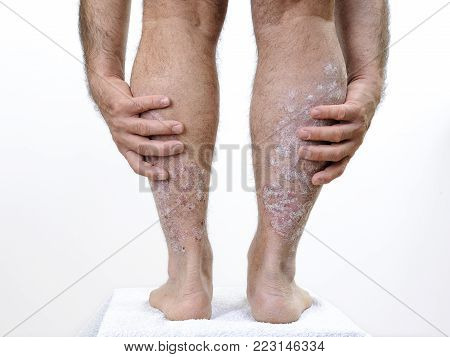 Close up of the back of the legs of a person suffering from chronic psoriasis, on a white background.