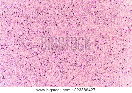 Abnormal red blood cells in Blood smear Thalassemia patient.
