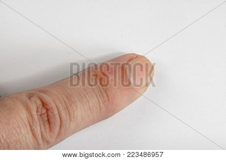 Ganglion Cysts