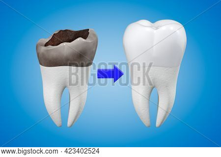 The Concept Of Prosthetics For A Damaged Tooth With A Metal-ceramic Crown. Carious Tooth And Dental 