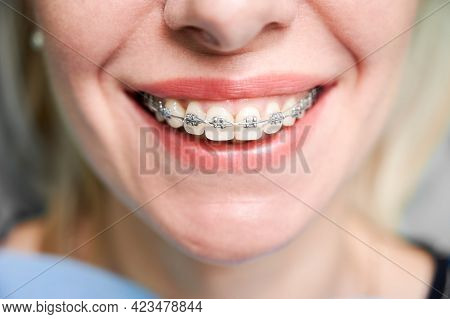 Close Up Of Woman With Charming Smile Demonstrating White Teeth With Orthodontic Brackets. Female Pa