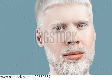 Albinism Concept. Portrait Of Young Bearded Albino Man With White Hair, Pale Skin And Blue Eyes, Tur