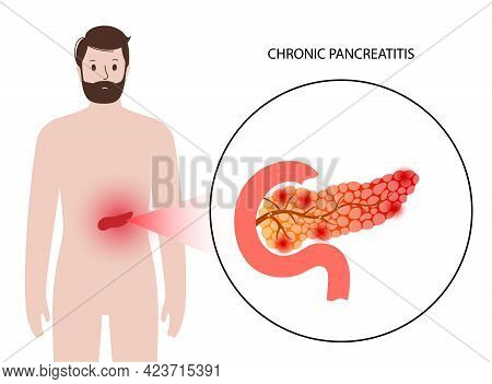 Pancreas Disease Logo, Chronic Pancreatitis. Medical Appointment And Treatment In Clinic. Pain And I