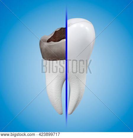 The Concept Of Prosthetics For A Damaged Tooth With A Metal-ceramic Crown. Carious Tooth And Dental 