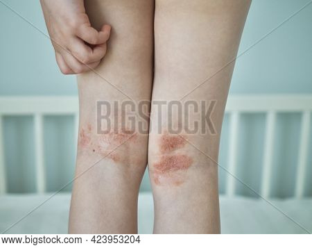 Atopic Dermatitis Close Up. Allergy Spots And Red Itchy Skin Inflammation On Child's Feet. Eczema On