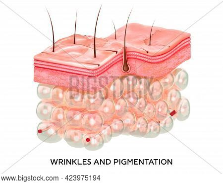 Skin With Wrinkles And Age Spots. 3d Illustration Of The Structure Of The Skin Layers Microstructure