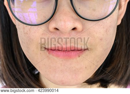 Close Up Of Woman Face Has Variety Problems On Her Skin (such As Acne, Pimple, Pores And Melasma Etc