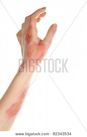 Horrible burns on female hand isolated on white