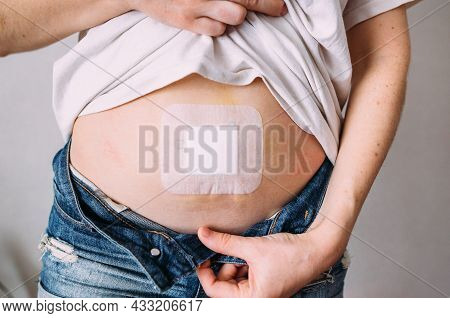 Female Belly After A Medical Operation. Elimination Of The Umbilical Hernia.