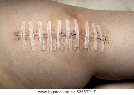 Total Knee Replacement