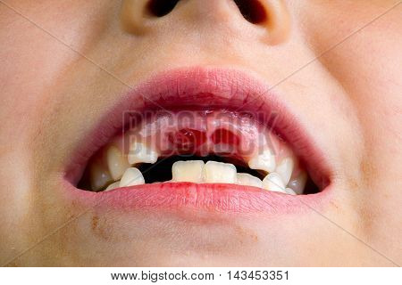Close up image of the mouth of a little girl who just lost her two front teeth. There are new teeth growing in where the old ones have fallen out and the holes still have some blood in them.