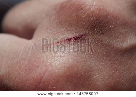 Scratch on the back of the hand. Minor injuries. Drops of blood.