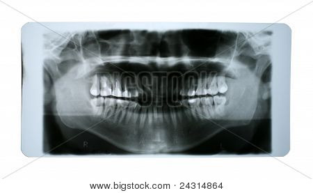 เอ็กซ์เรย์ปากมนุษย์ไส้