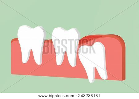 Wisdom Tooth ( Angular Or Mesial Impaction ) With Inflammation Affect To Other Teeth - Dental Cartoo