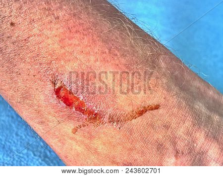 Wound On Leg After A Traffic Accident. Hurt Adult Body. Wet Bloody Place.