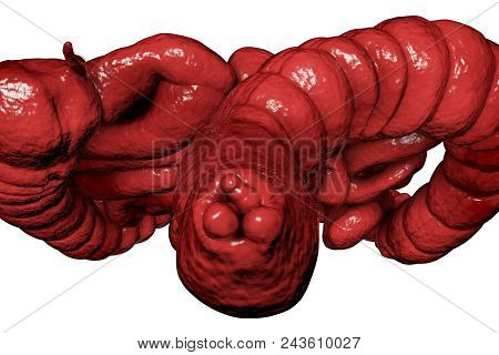 Hemorrhoids, Bottom View Of Hemorrhoic Nodules Inside Anus, Large And Small Intestine Are Also Shown