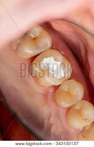 Treatment Of The Roots Of The Tooth. Sealing And Cleaning A Carious Human Tooth Close-up Of A Macro.