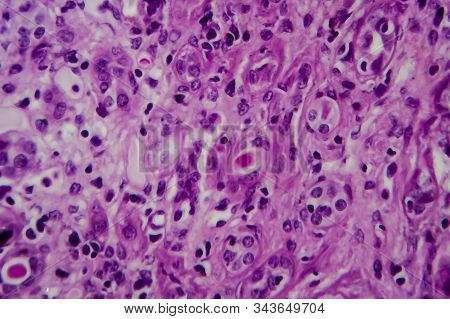 Chronic Glomerulonephritis, Light Micrograph, Photo Under Microscope. High Magnification