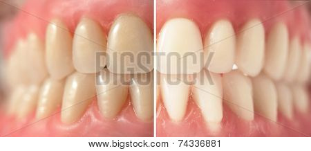 Teeth whitening, before and after shots