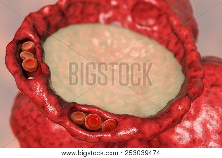 Pulmonary Edema, Close-up View Of Alveolus Cross-section Showing Liquid In Alveolus, Dilated Capilla
