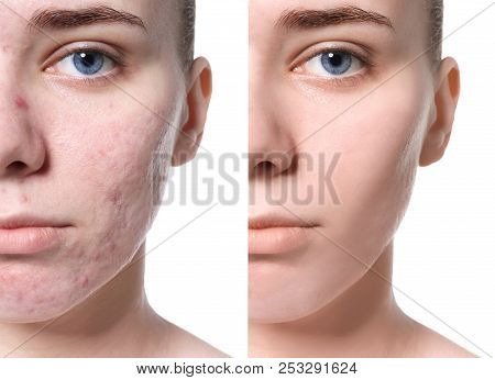 Young Woman With Acne Problem On White Background