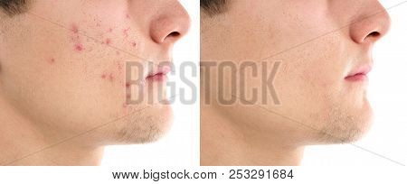 Young Man With Acne Problem On White Background
