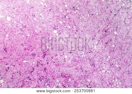 Liposarcoma, Soft Tissue Sarcoma, Light Micrograph, Photo Under Microscope