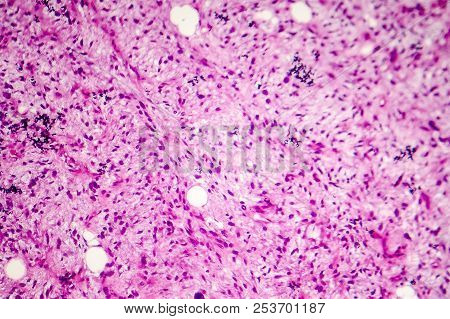 Liposarcoma, Soft Tissue Sarcoma, Light Micrograph, Photo Under Microscope