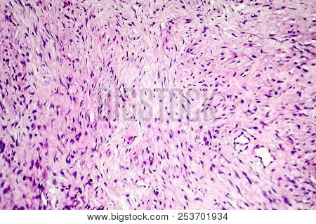 Fibroma, A Benign Tumour Of Fibrous Tissue, Light Micrograph, Photo Under Microscope