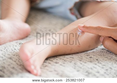 Mother Applying Cream On A Girl's Legs With Red Spot, Blister. Medicine And Health Care Concept.