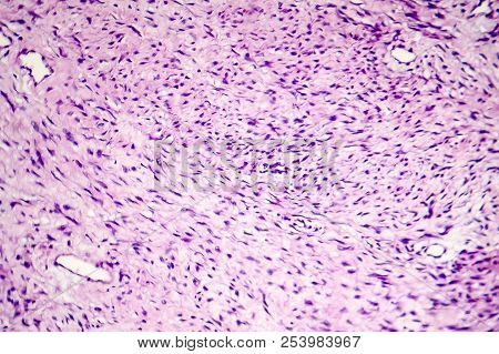 Fibroma, A Benign Tumour Of Fibrous Tissue, Light Micrograph, Photo Under Microscope