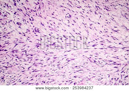 Fibroma, A Benign Tumour Of Fibrous Tissue, Light Micrograph, Photo Under Microscope